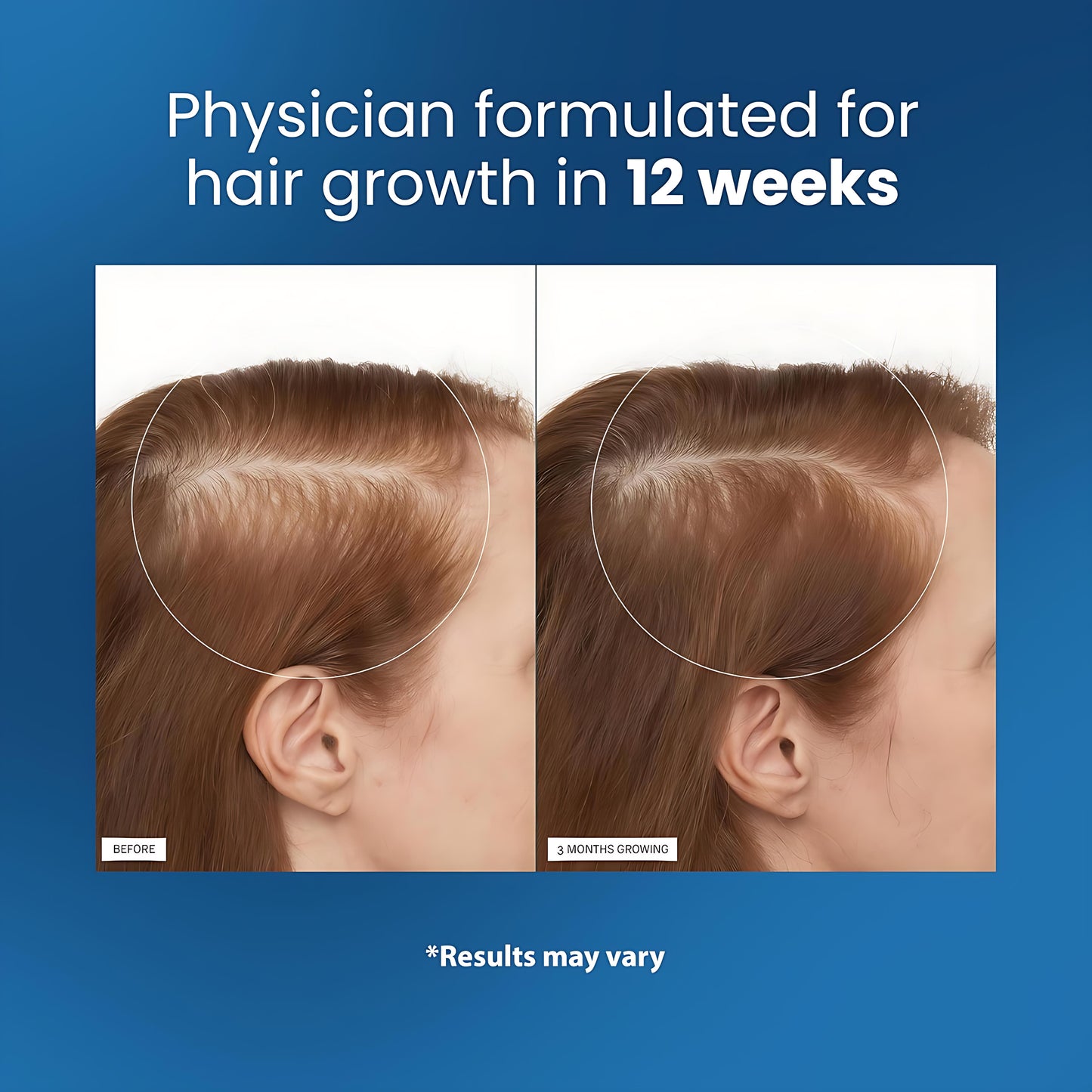 Rosemary Hair Growth Serum Roll On 25 ml – 3% Rosemary, 3% Redensyl & 2% Anagain | DHT-Blocking Scalp Serum Boosts Oxygen Flow, Reduces Hair Fall | Paraben/Sulfate-Free | Women & Men