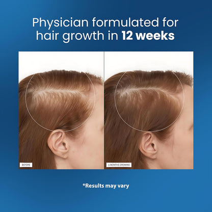 Rosemary Hair Growth Serum Roll On 25 ml – 3% Rosemary, 3% Redensyl & 2% Anagain | DHT-Blocking Scalp Serum Boosts Oxygen Flow, Reduces Hair Fall | Paraben/Sulfate-Free | Women & Men